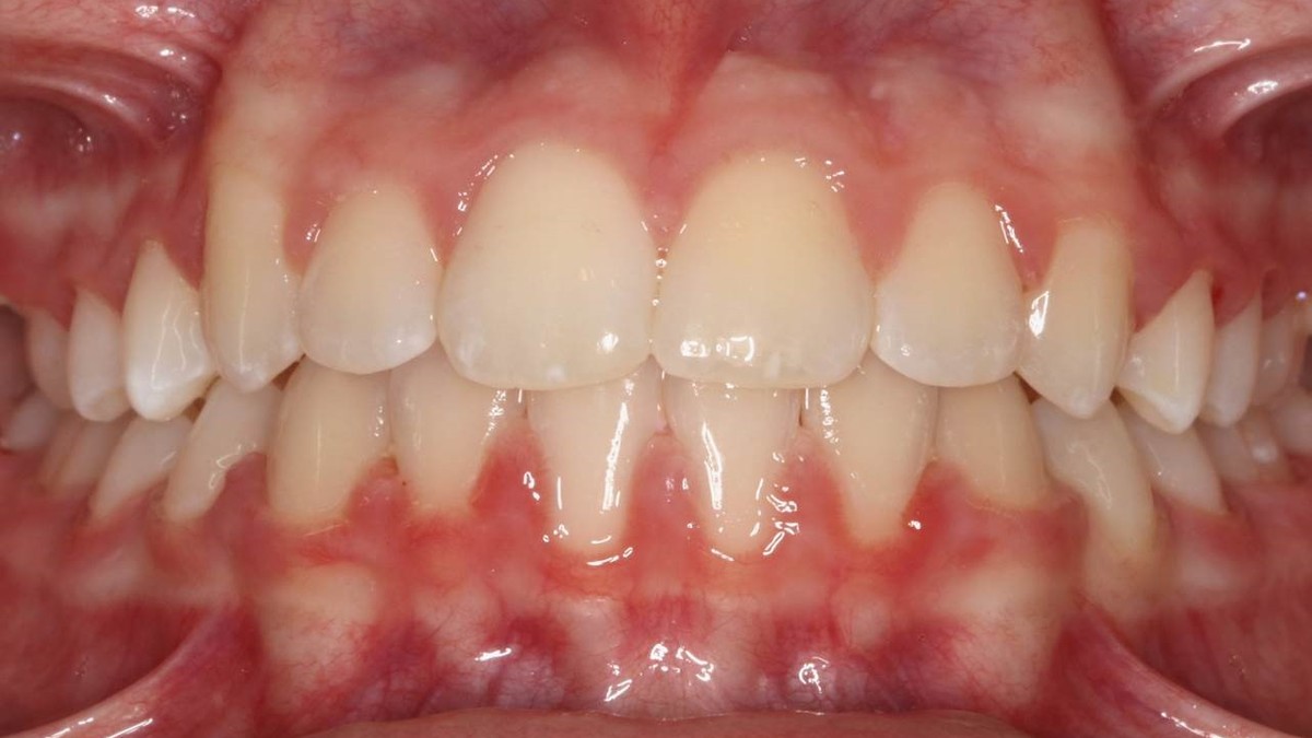 After treatment: corrected crossbite