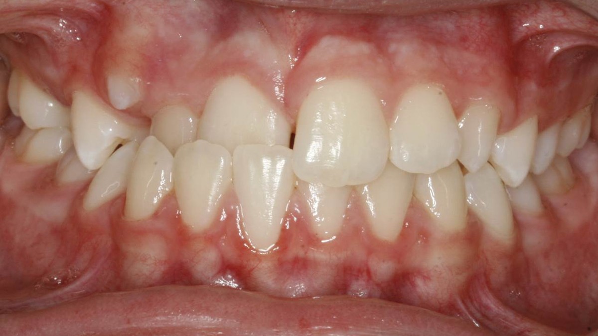 Before treatment: crossbite on the right molar