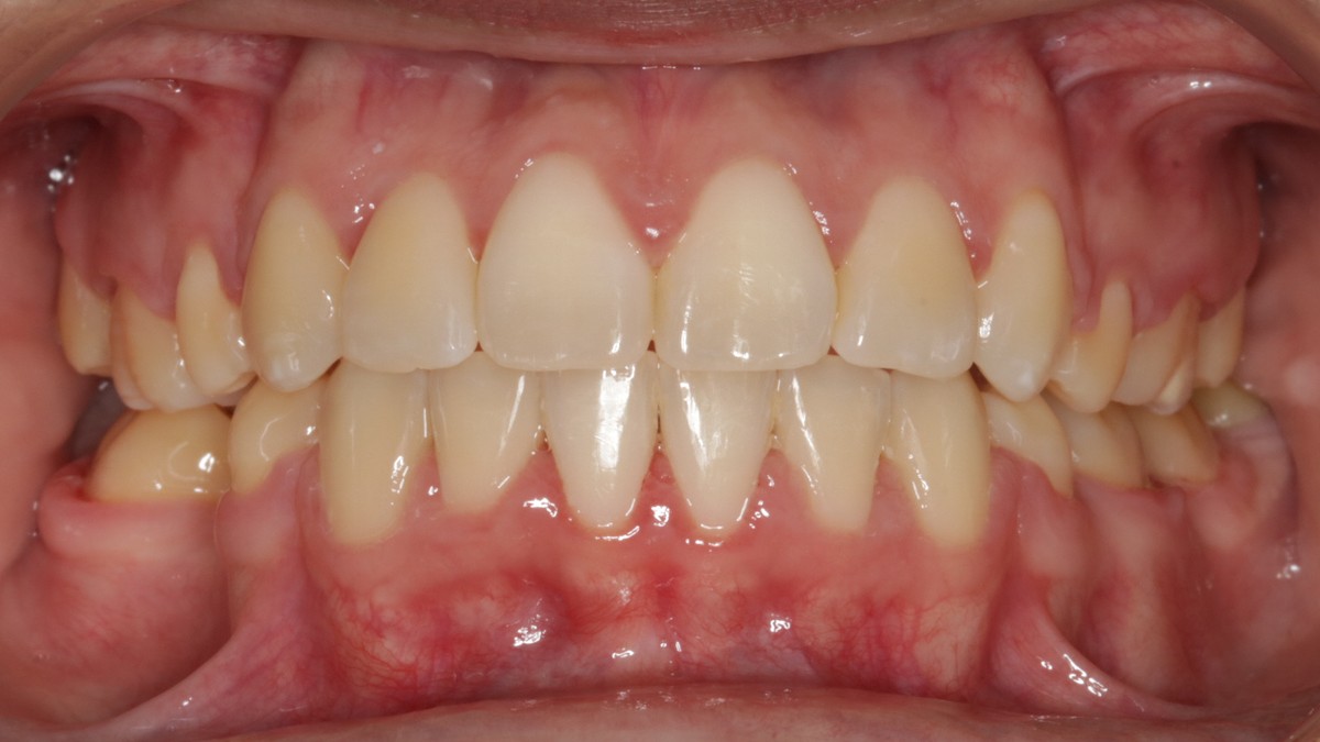 After treatment: aligned upper and lower arches