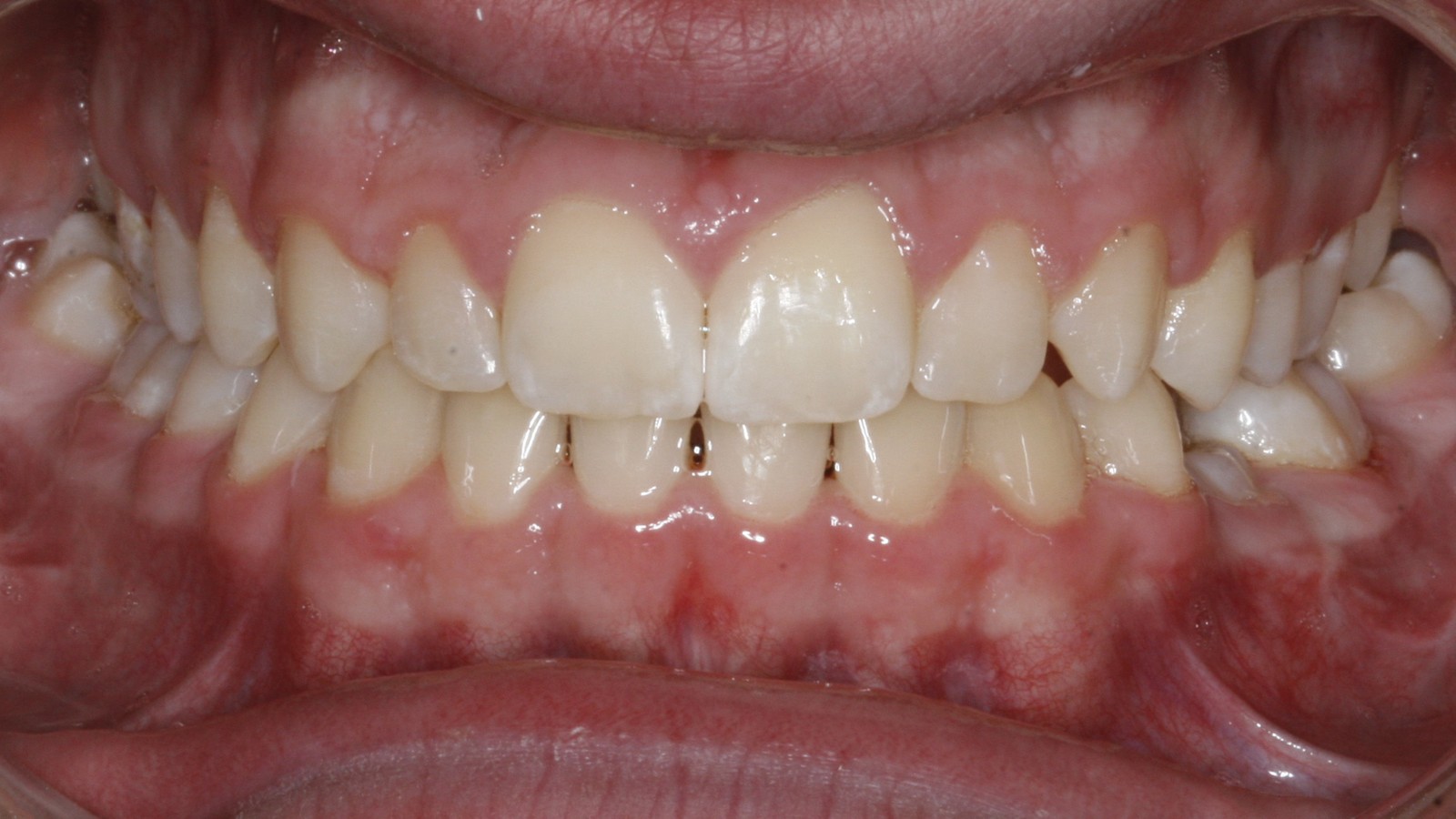 After treatment: corrected overbite