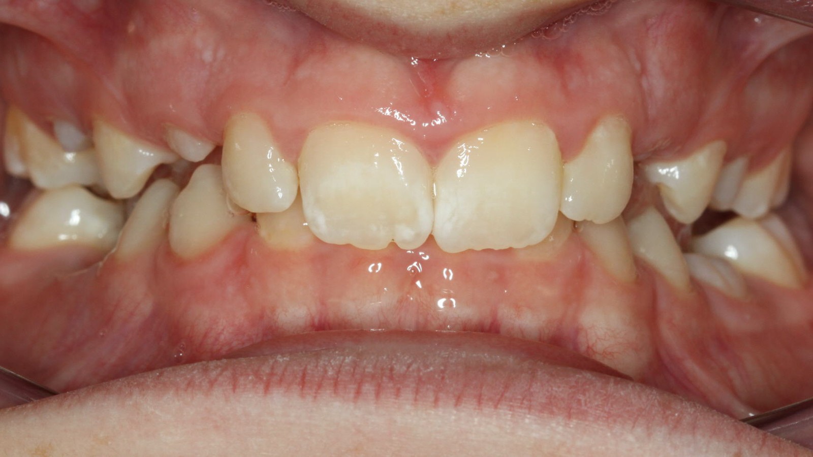Before treatment: deep overbite