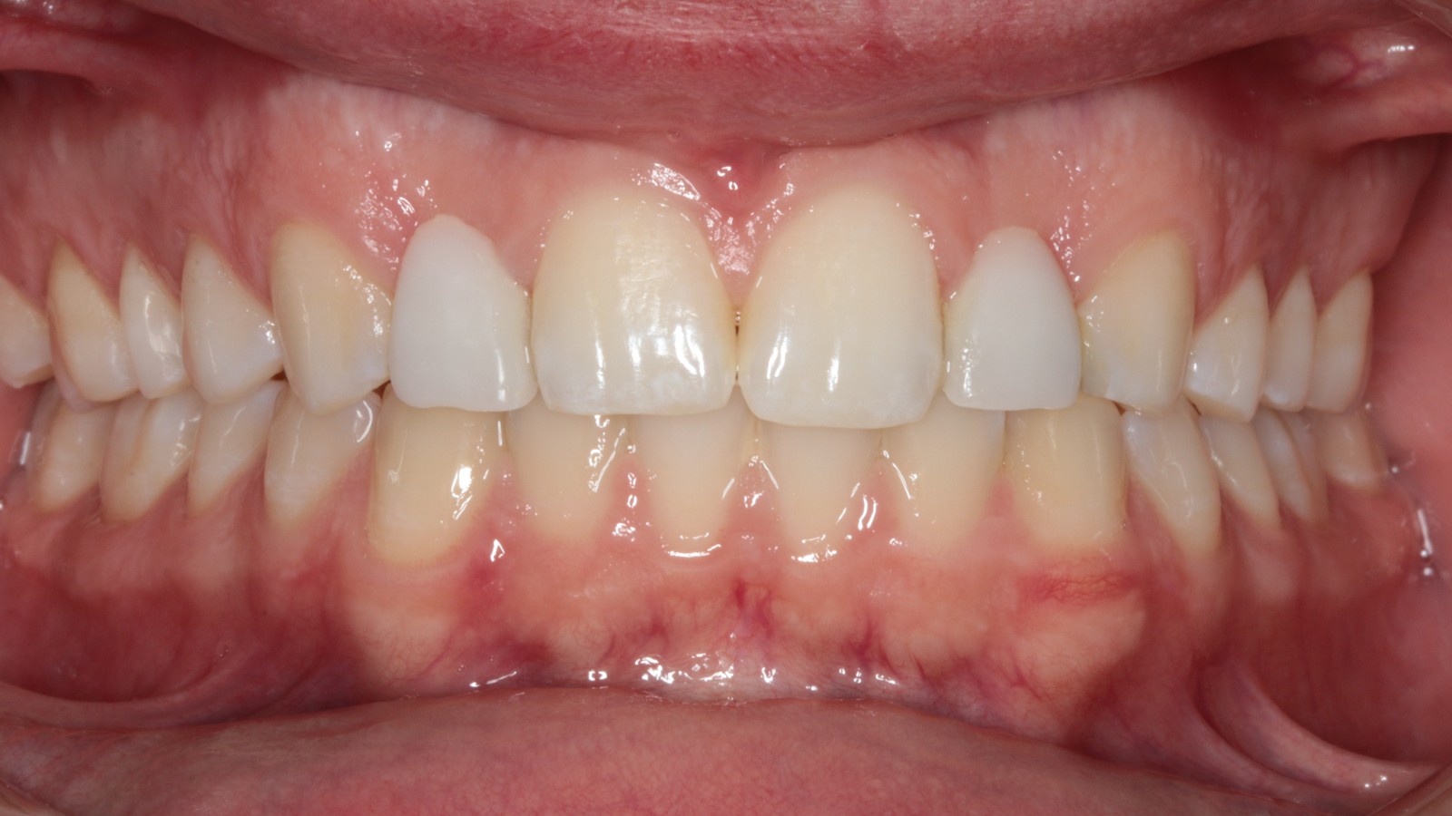 After treatment: spaces closed and the bite aligned
