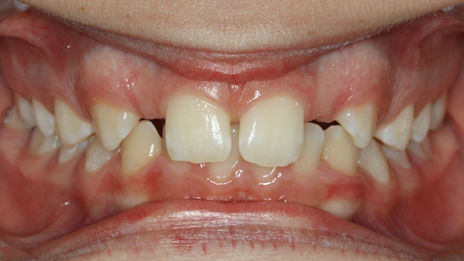 Before treatment: spaces where the upper lateral incisors are absent