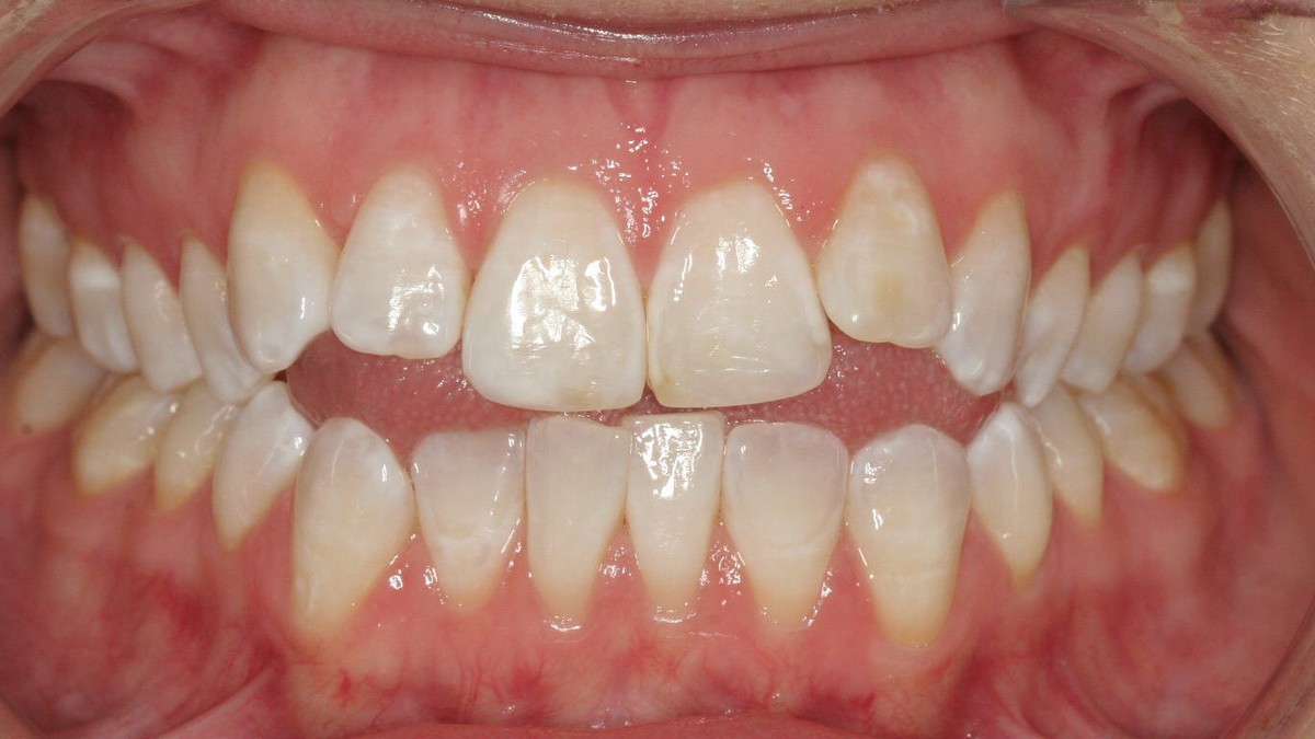 Before treatment: open bite with the front teeth not meeting