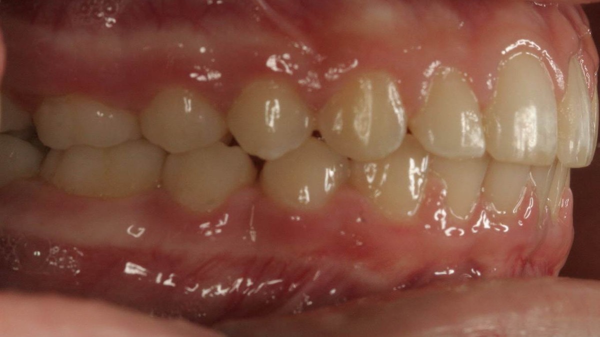 After treatment: corrected overjet, side view