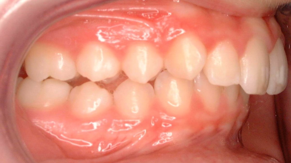 Before treatment: overjet with the upper front teeth projecting forward, side view