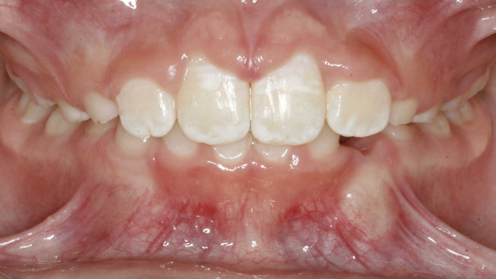 After treatment: guided into alignment after early treatment