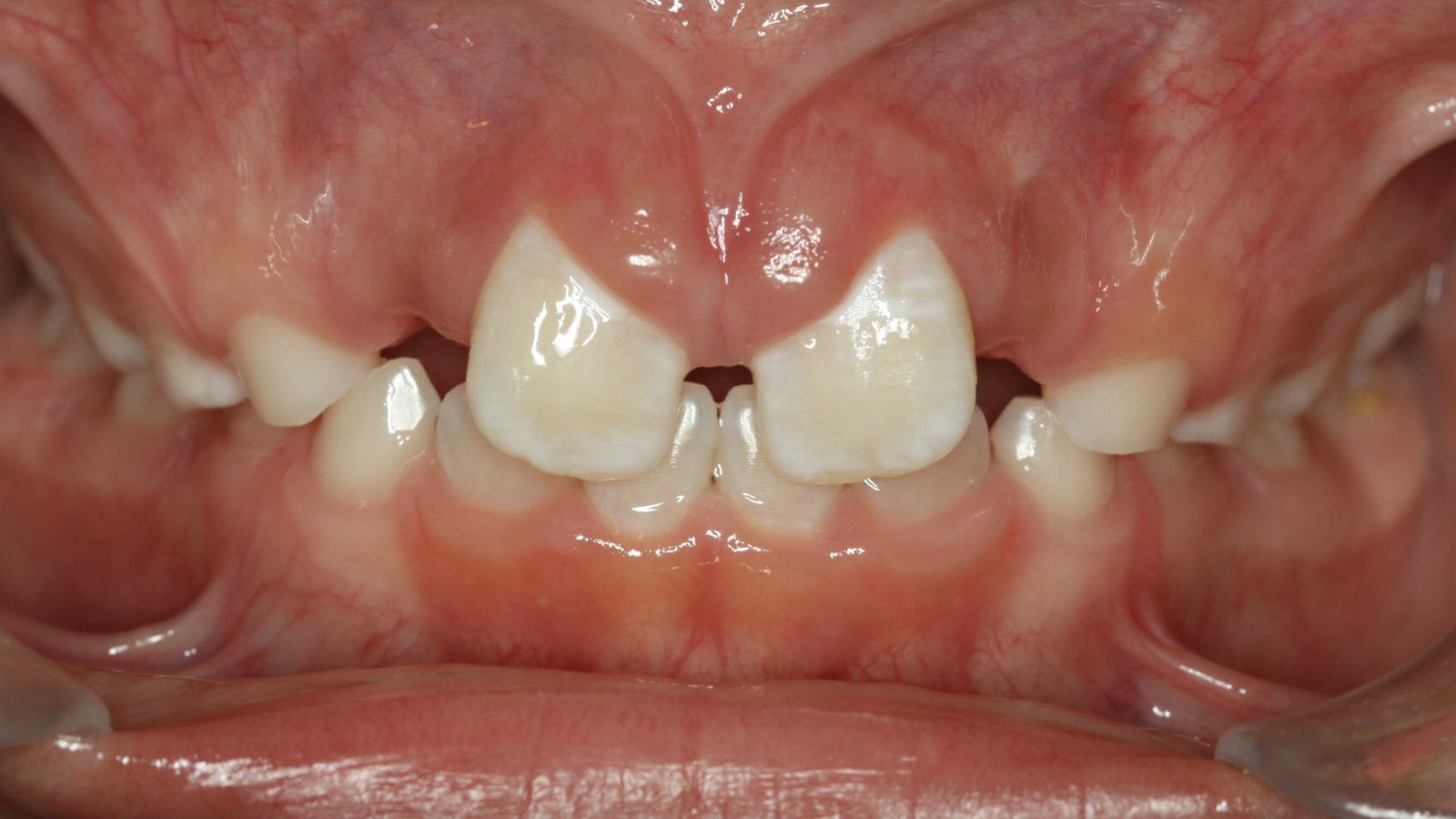 Before treatment: crowding and displaced teeth in a developing bite